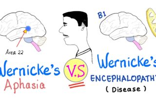 Broca’s Aphasia Vs Wernicke’s Aphasia